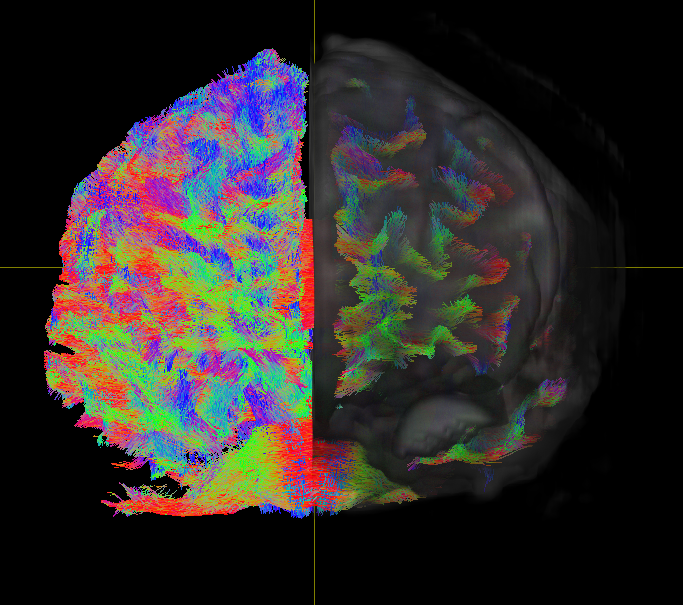 Using Deep Learning And Brain MRI To Detect ADHD - Thailand Medical News