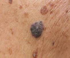 Brachytherapy Effective In Treating Skin Cancer Thailand Medical News