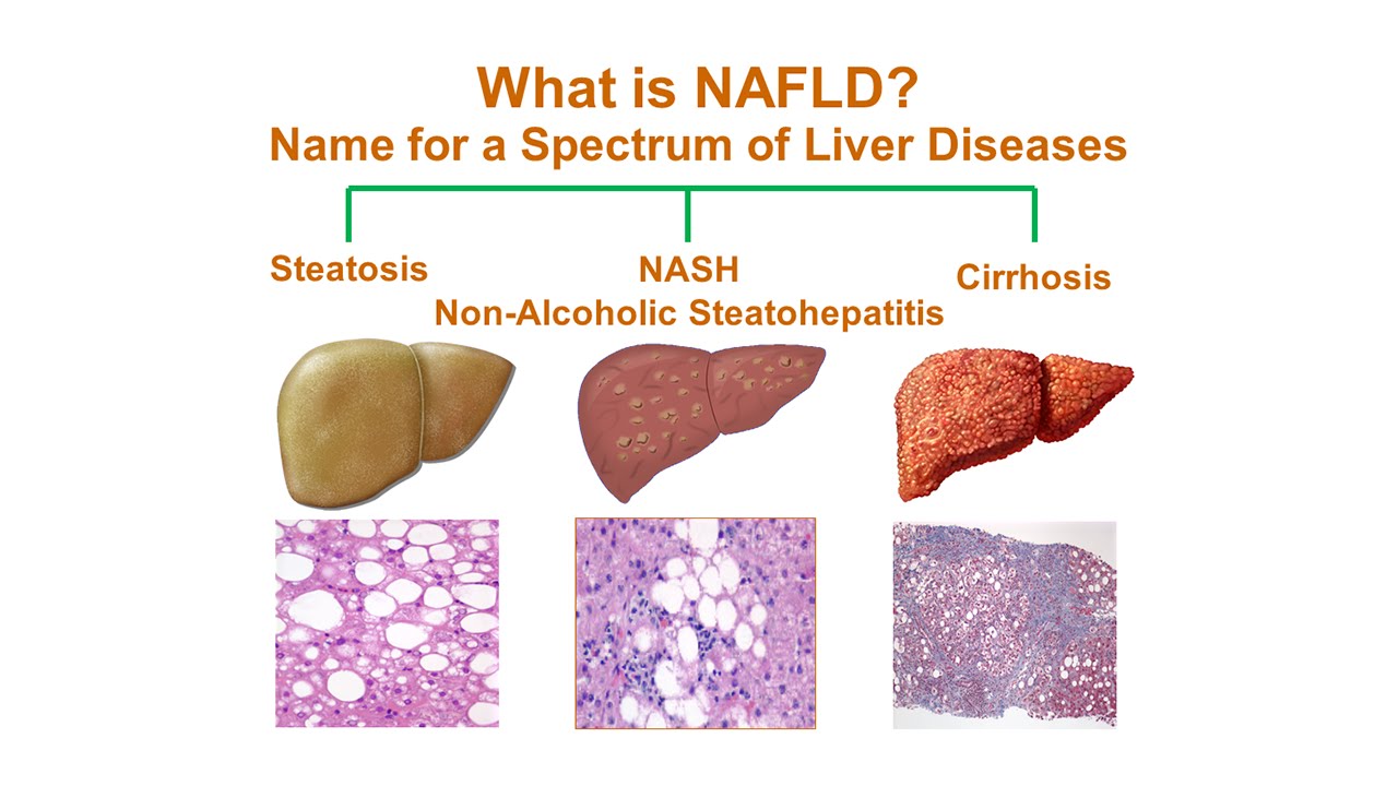 Non alcoholic liver disease