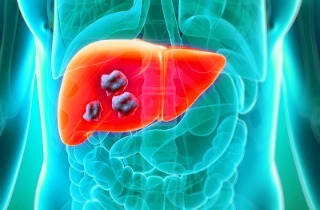 Liver Cancer: American Researchers Identify Metabolic Enzyme That ...